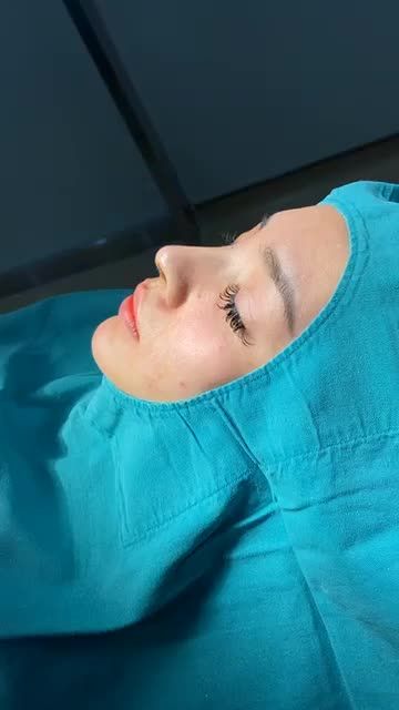 NÂNG MŨI CẤU TRÚC SOFTXIL KIẾN TẠO DÁNG MŨI ĐỈNH CAO