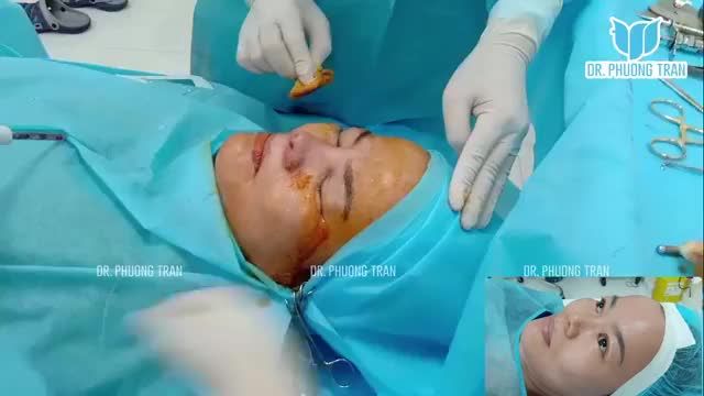 Vừa hoàn thành 1 ca nâng mũi cấu trúc