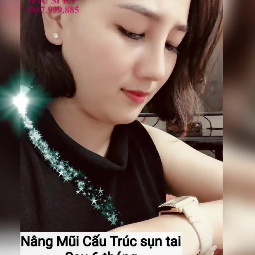 Khách hàng nâng mũi tại Bác sĩ Kỳ