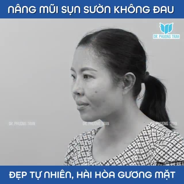 SỰ THẬT KHI NÂNG MŨI SỤN SƯỜN Ở TRUNG TÂM BÁC SĨ TRẦN PHƯƠNG