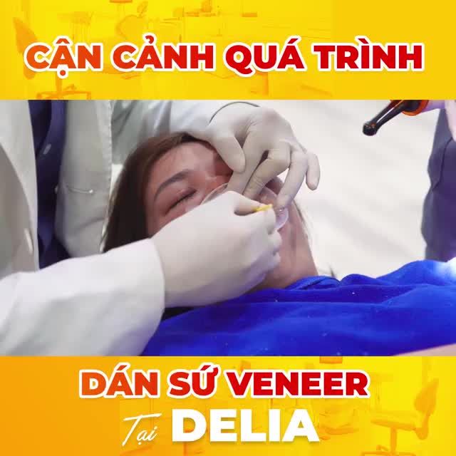 CẬN CẢNH QUÁ TRÌNH DÁN SỨ VENEER TẠI DELIA XEM NGAY!