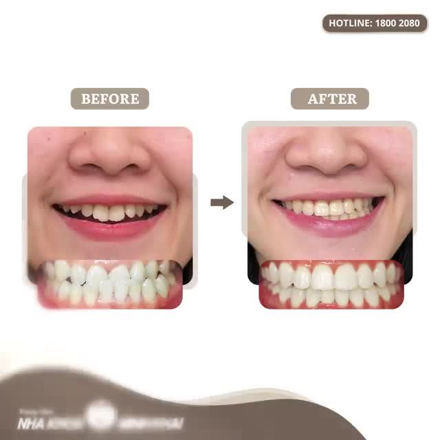 Cứu vãn hàm răng móm cùng bác sĩ Minh Khai