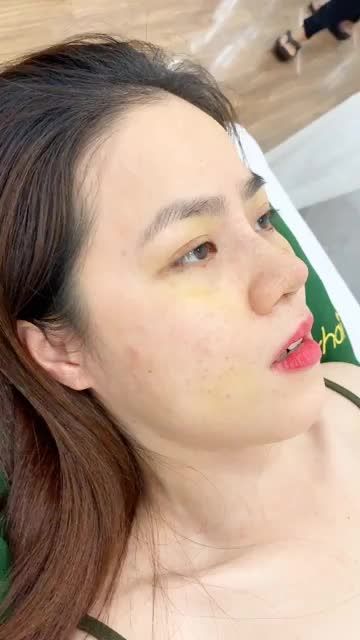 Lúc trước L.T không dám nâng mũi vì sợ đau, tuy nhiên với sự động viên của má nuôi, cô ấy đã can đảm đến Bác sĩ để thay đổi dáng mũi của mình.