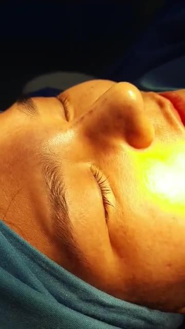 NÂNG MŨI BÁN CẤU TRÚC ĐA LỚP NHÀ BS KỲ Y DƯỢC