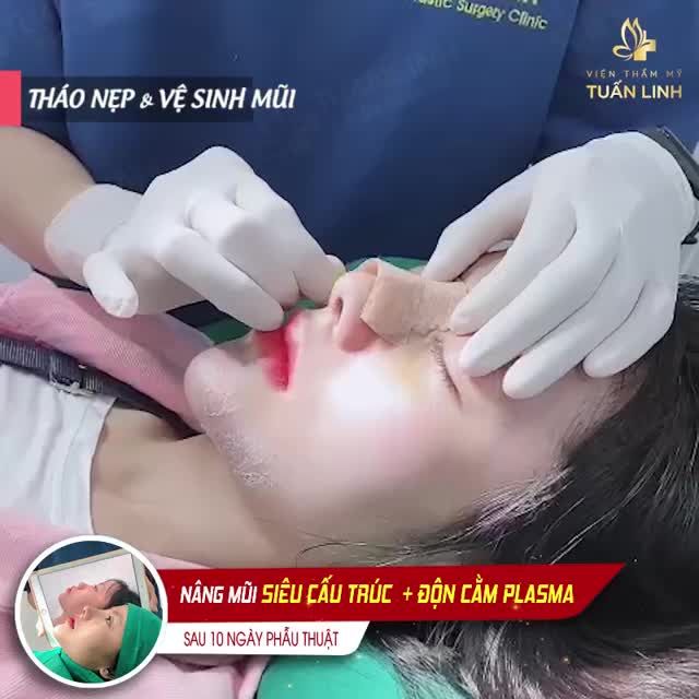 NÂNG MŨI SIÊU CẤU TRÚC  ĐỘN CẰM PLASMA