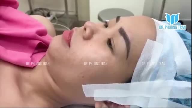 NÂNG MŨI SỤN SƯỜN TOÀN PHẦN NÓI KHÔNG VỚI ĐÀO THẢI CHẤT LIỆU