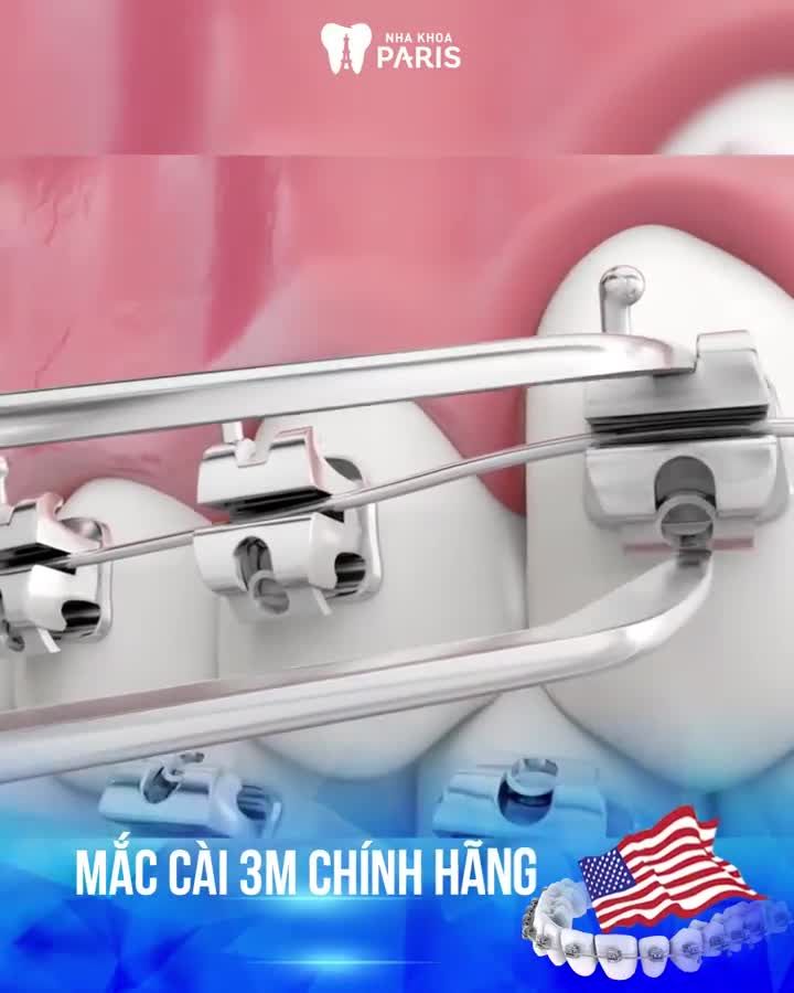 Răng Hô Thưa  Móm  Khấp Khểnh???