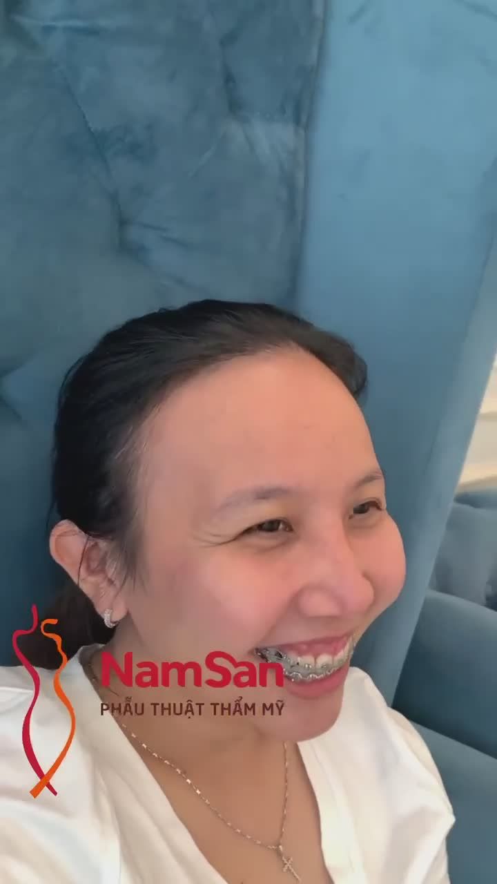 Tái khám nâng mũi sụn tai bọc cân thái dương