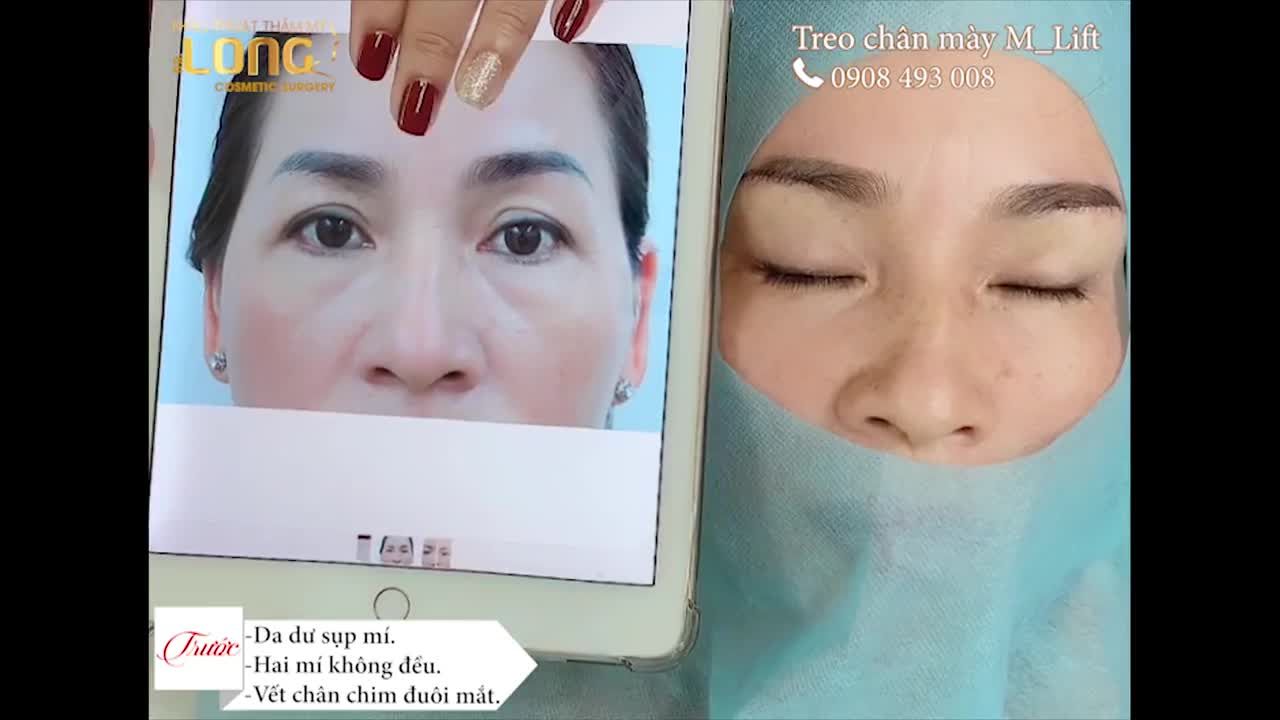 Treo chân mày M Lift giúp khuôn mặt bạn thay đổi như thế nào