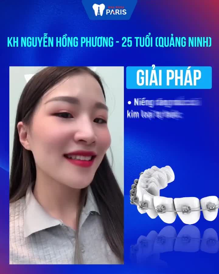 6 tháng niềng răng XÔ LỆCH Lột xác nhan sắc
