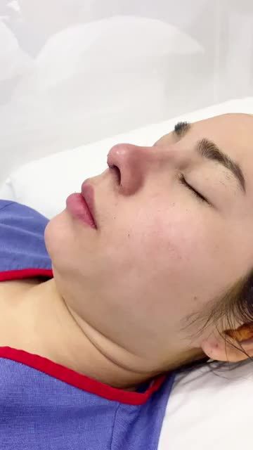 Wow!!! Nâng mũi cấu trúc 4D siêu âm chỉnh xương Dáng mũi đẹp mọi góc độ ngay sau làm
