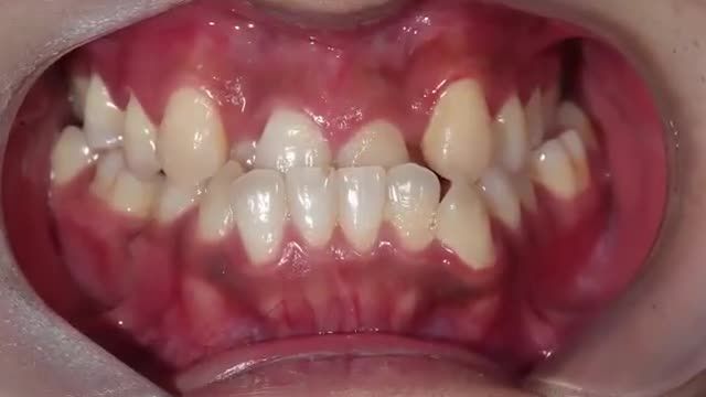 BẠN ĐÃ VƯỢT QUA CÁM DỖ "BỌC RĂNG SỨ" và LỰA CHỌN NIỀNG RĂNG NHƯ THẾ NÀO?