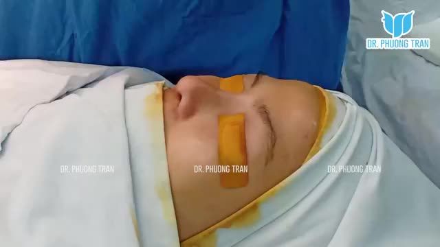 Cùng Bs.Trần Phương khắc phục chiếc mũi đã 4 lần thực hiện nhưng chưa thành công