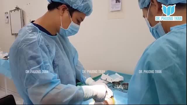 CẬN CẢNH NÂNG MŨI ĐẶT SỐNG SURGIFORM