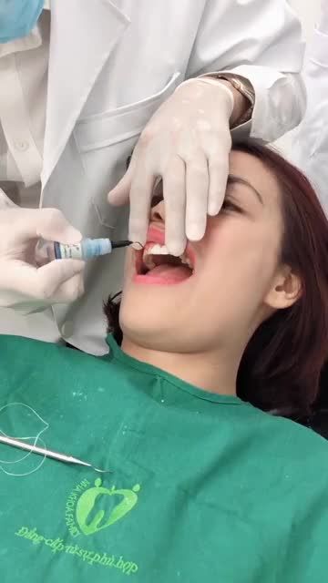 DÁN VENEER SỨ SIÊU MỎNG CHỈ TỪ 3TR/RĂNG