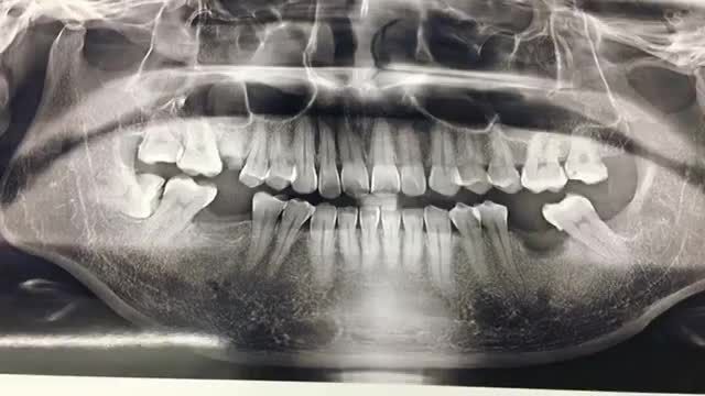 Ca trồng răng implant răng 46 cho anh Chiến tại Nha Khoa Thuỳ Anh.