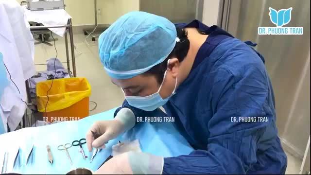 MŨI CẤU TRÚC SỤN SƯỜN TOÀN PHẦN