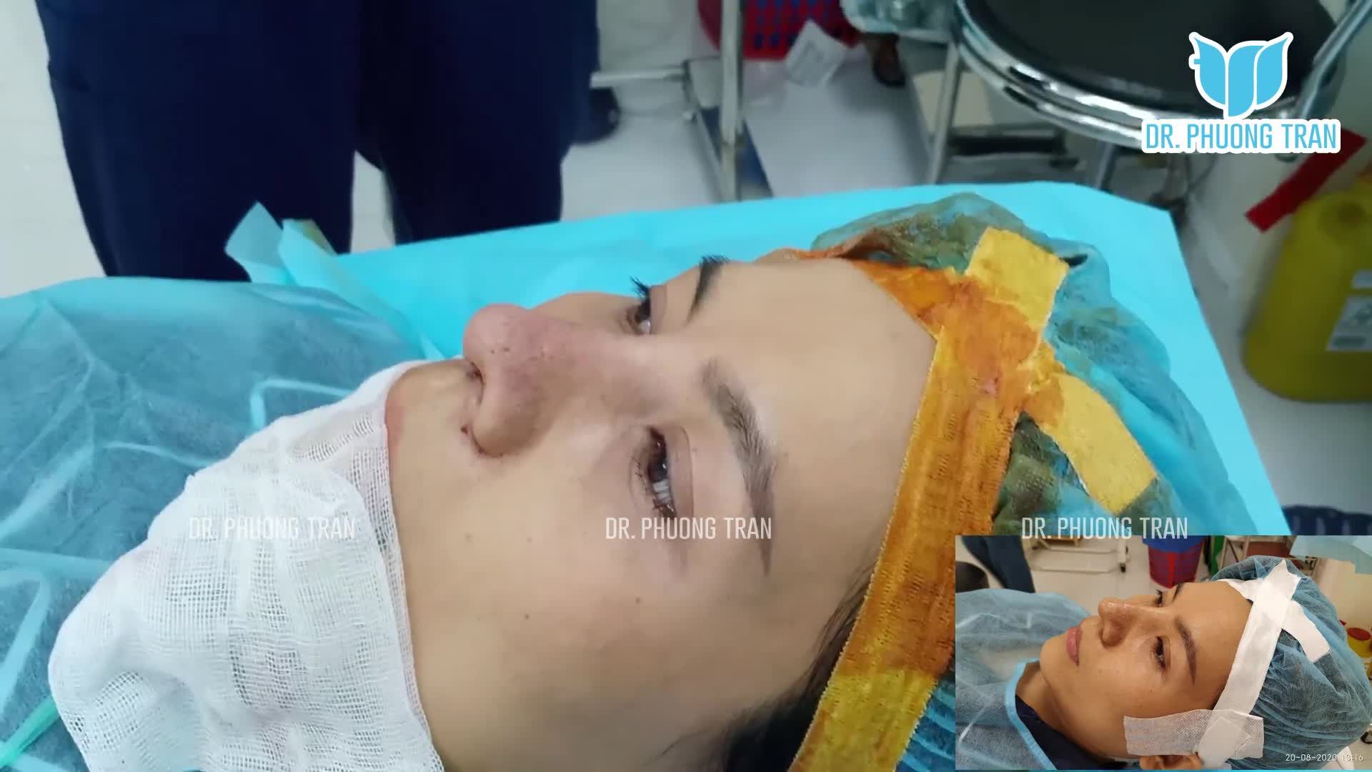 Ca nâng mũi cấu trúc lần 3 hôm nay