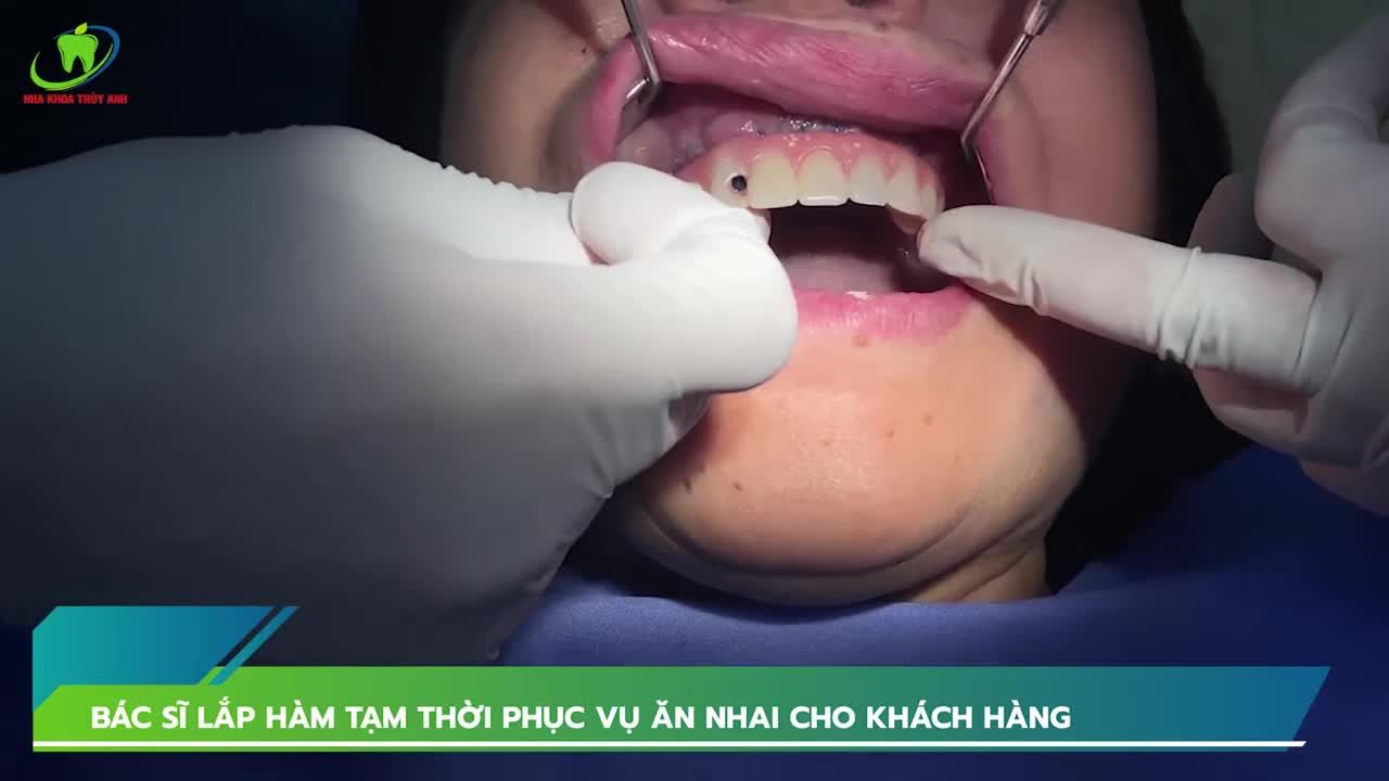LẮP RĂNG TẠM CHỈ SAU 48H TRỒNG RĂNG TOÀN HÀM ALL ON 4