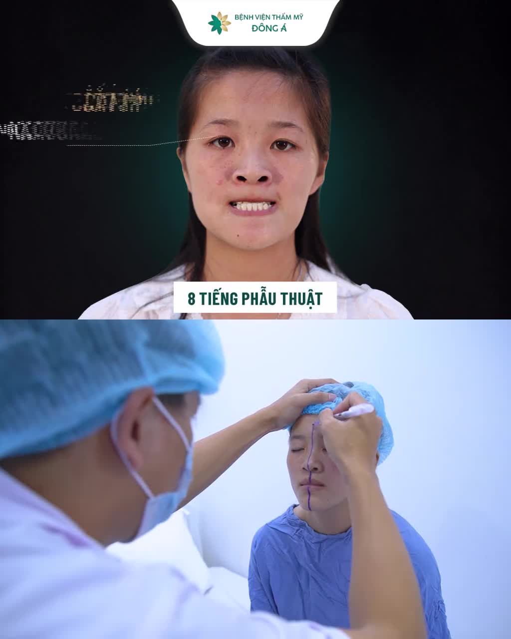 Hàm móm Mặt gầy Mũi thấp, to bè  Mí lót, sụp buồn