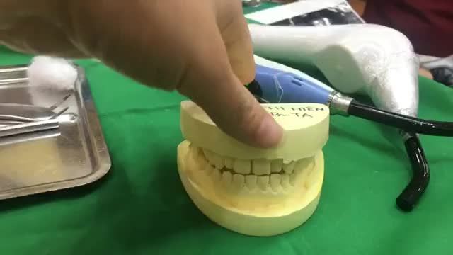 Ca gắn mắc cài hàm dưới cho bạn khách hàng tại Nha Khoa Thuỳ Anh.