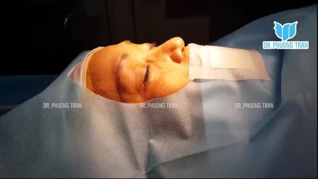 NÂNG MŨI CẤU TRÚC SỤN SƯỜN TOÀN PHẦN KHẮC PHỤC MŨI TO BÈ, LỆCH