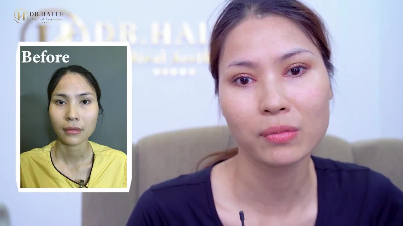 Nếu bạn đang lo lắng 7 ngày sau thẩm mỹ mắt, mí đã hết sưng và bầm tím chưa