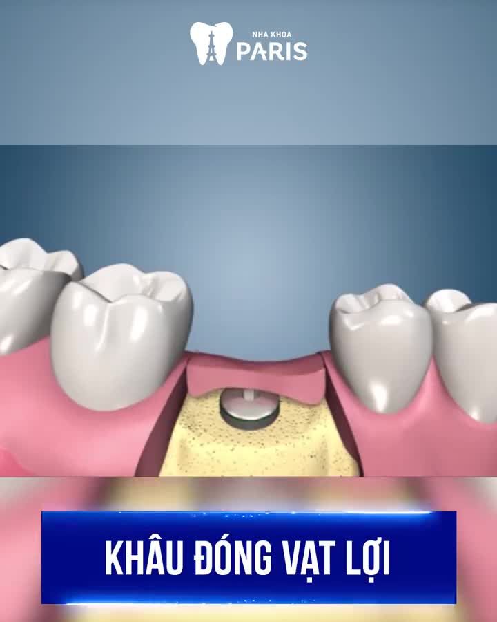 Mất răng Ăn nhai kém Tiêu xương Hóp Má