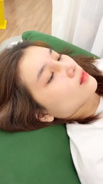 CẬN CẢNH NÂNG MŨI CẤU TRÚC SAU 10 NGÀY ƯU ĐÃI 3TR KHI NÂNG MŨI!