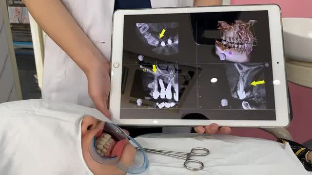 Case BN đặc biệt với tình trạng lâm sàng rất hiếm gặp.  Implant thông mũi