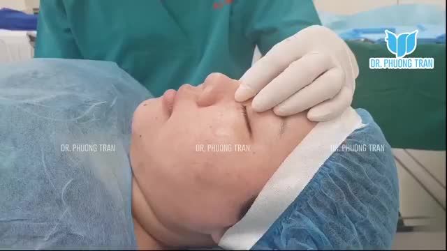 MỘT CA MŨI TƯƠNG ĐỐI KHÓ