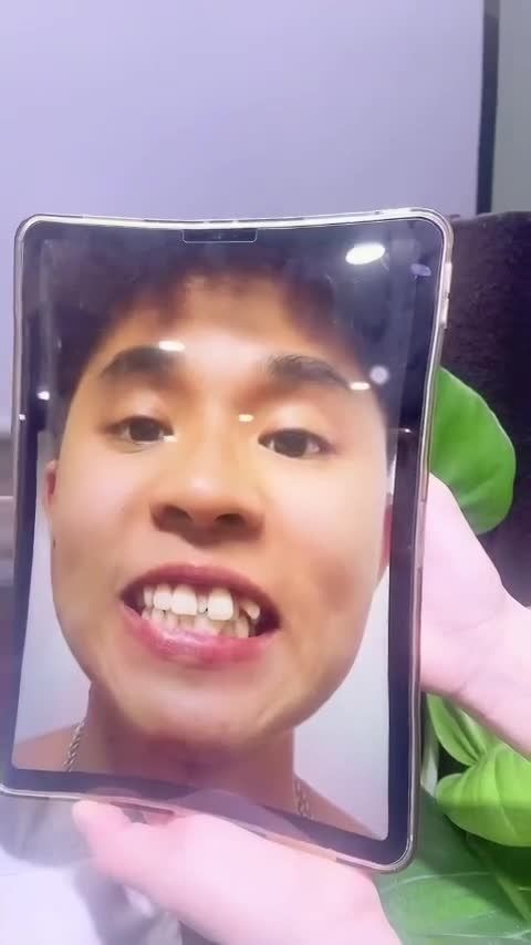 NGUYỄN HOÀNG HUY (Nam Định) Kết quả đạt được sau gần 1 năm Nắn Chỉnh tại nha khoa XS