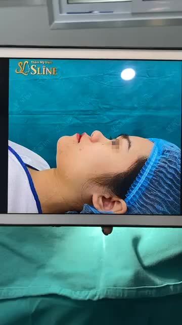 NHAN SẮC LÊN HƯƠNG SAU 45P NÂNG MŨI CẤU TRÚC SOFTXIL