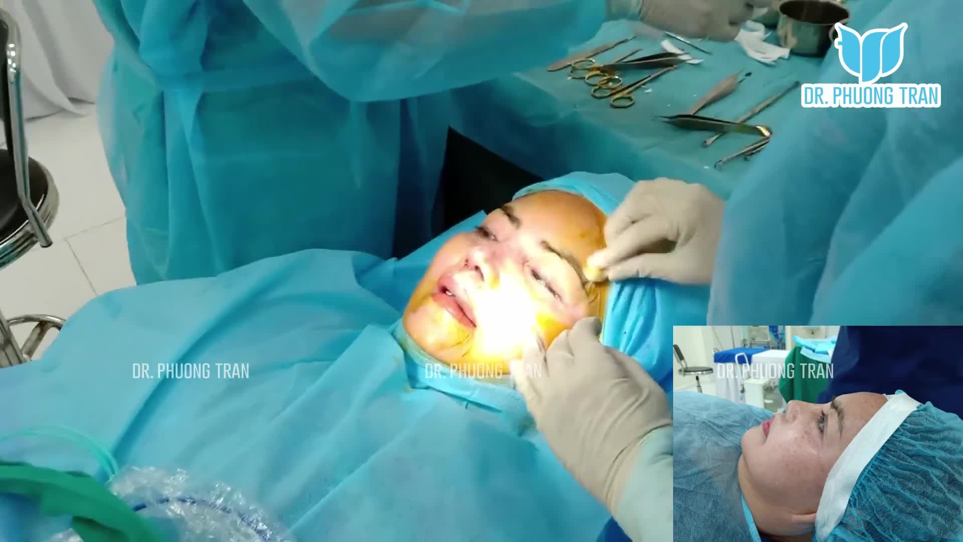 Lần nâng mũi thứ 4 có gì đặc biệt?