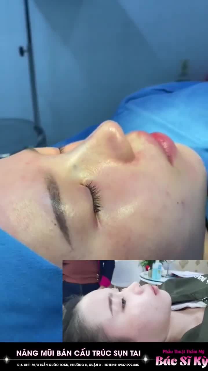 NÂNG MŨI, XỬ LÝ TRỤ MŨI LỆCH BẨM SINH