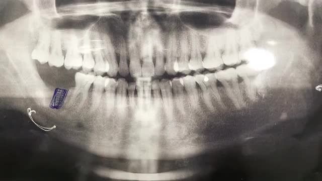 cấy chân răng nhân tạo implant tại Nha Khoa Thuỳ Anh.