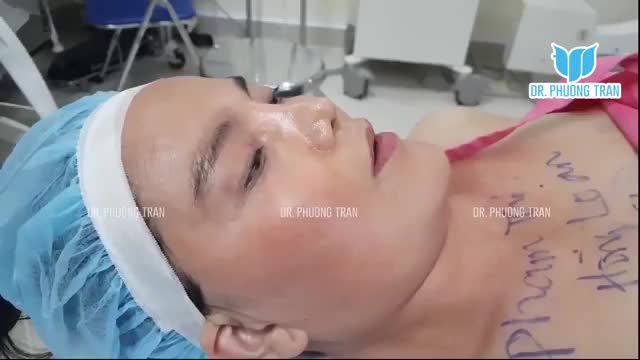 NÂNG MŨI CẤU TRÚC SỤN SƯỜN TOÀN PHẦN