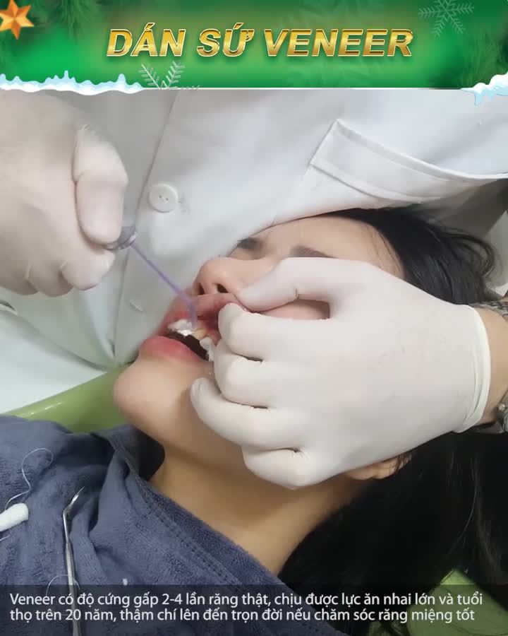 VENEER SỨ SIÊU MỎNG THAY MÀU ÁO MỚI CHO NỤ CƯỜI KHÔNG CẦN MÀI RĂNG