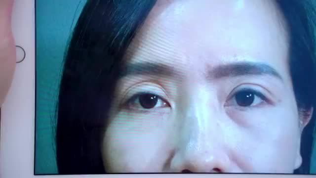 Dr.Hải Lê tiếp tục giải cứu thành công ca Mí lỗi hỏng do cắt mí tại cơ sở kém chất lượng không uy tín dẫn đến biến chứng về sức khỏe cũng như thẩm mỹ đôi mắt