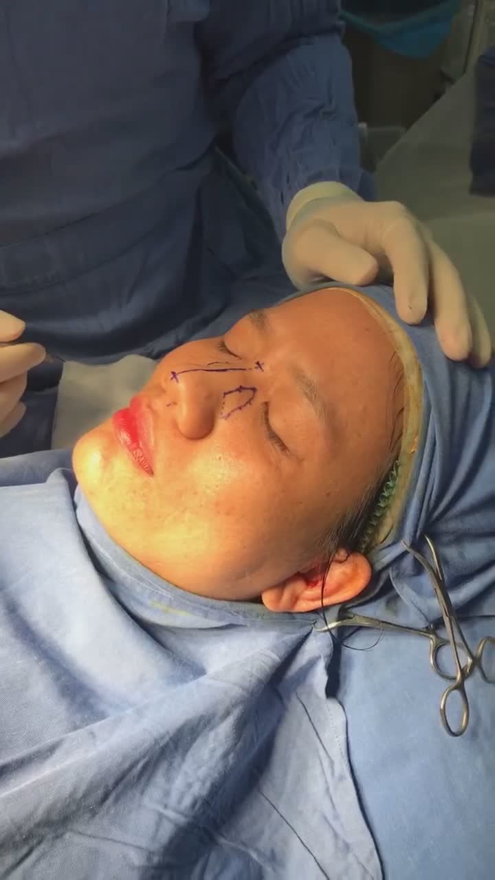 "Tận mắt" chứng kiến quá trình bác sĩ thực hiện phân tích và đo vẽ dáng mũi trước khi phẫu thuật