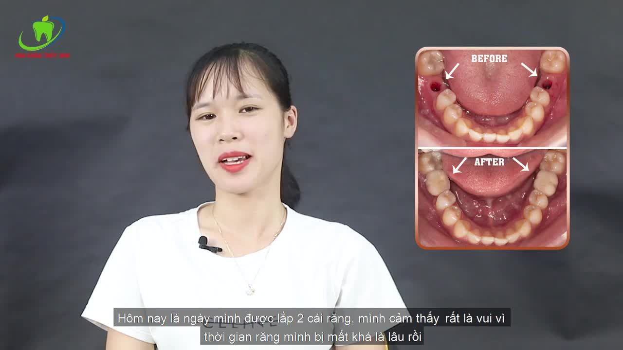 TRỒNG CÙNG LÚC HAI IMPLANT GIẢI PHÁP TỐT NHẤT ĐỂ KHÔI PHỤC LẠI CHIẾC RĂNG SỐ 6 ĐÃ MẤT.