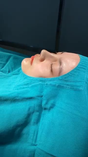 MŨI ĐẸP CHUẨN TỶ LỆ VÀNG SAU 45P NÂNG MŨI CẤU TRÚC