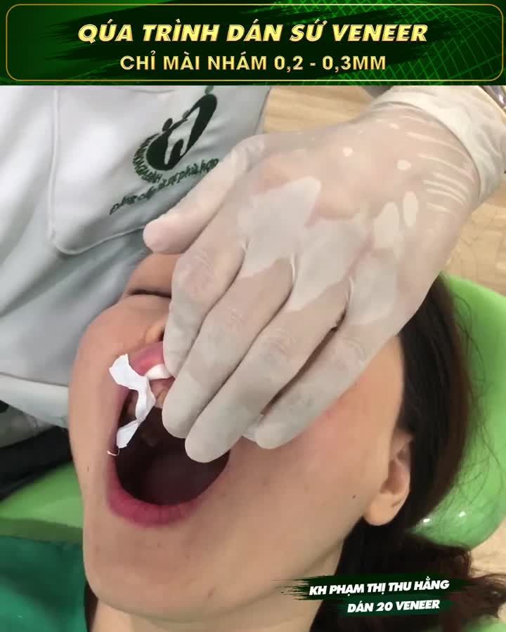 CẢM XÚC NHƯ VỠ OÀ SAU KHI SỞ HỮU NỤ CƯỜI MỚI