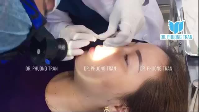 PHỎNG VẤN NHANH CẢM NHẬN CHỊ KHÁCH HÀNG THỰC HIỆN COMBO NÂNG MŨI SỤN SƯỜN TOÀN PHẦN CẤY MỠ