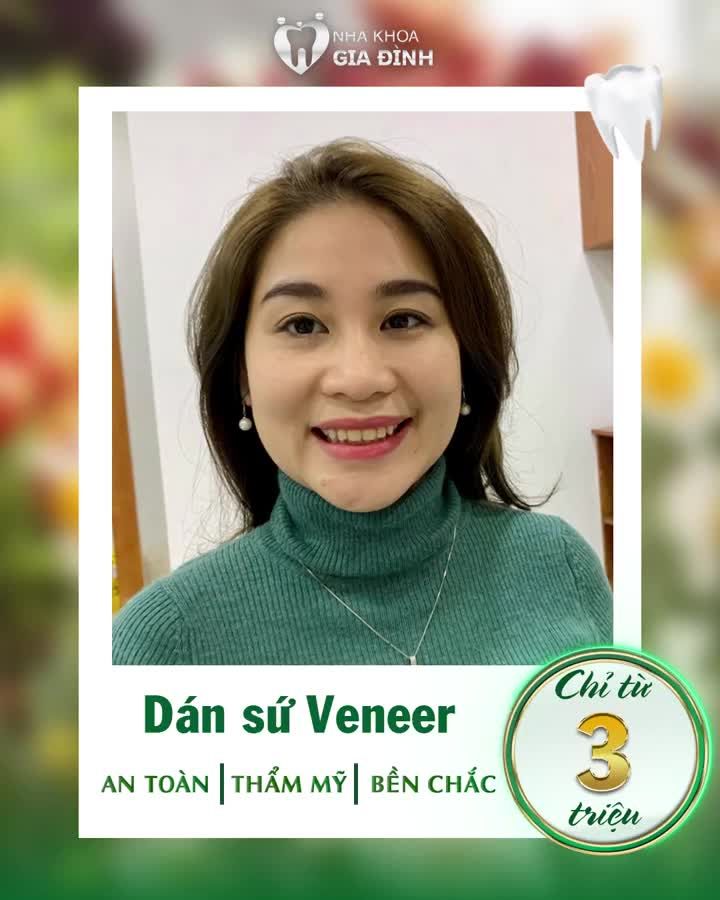 DÁN SỨ VENEER PHƯƠNG PHÁP THẨM MỸ RĂNG THÀNH CÔNG NHẤT HIỆN NAY