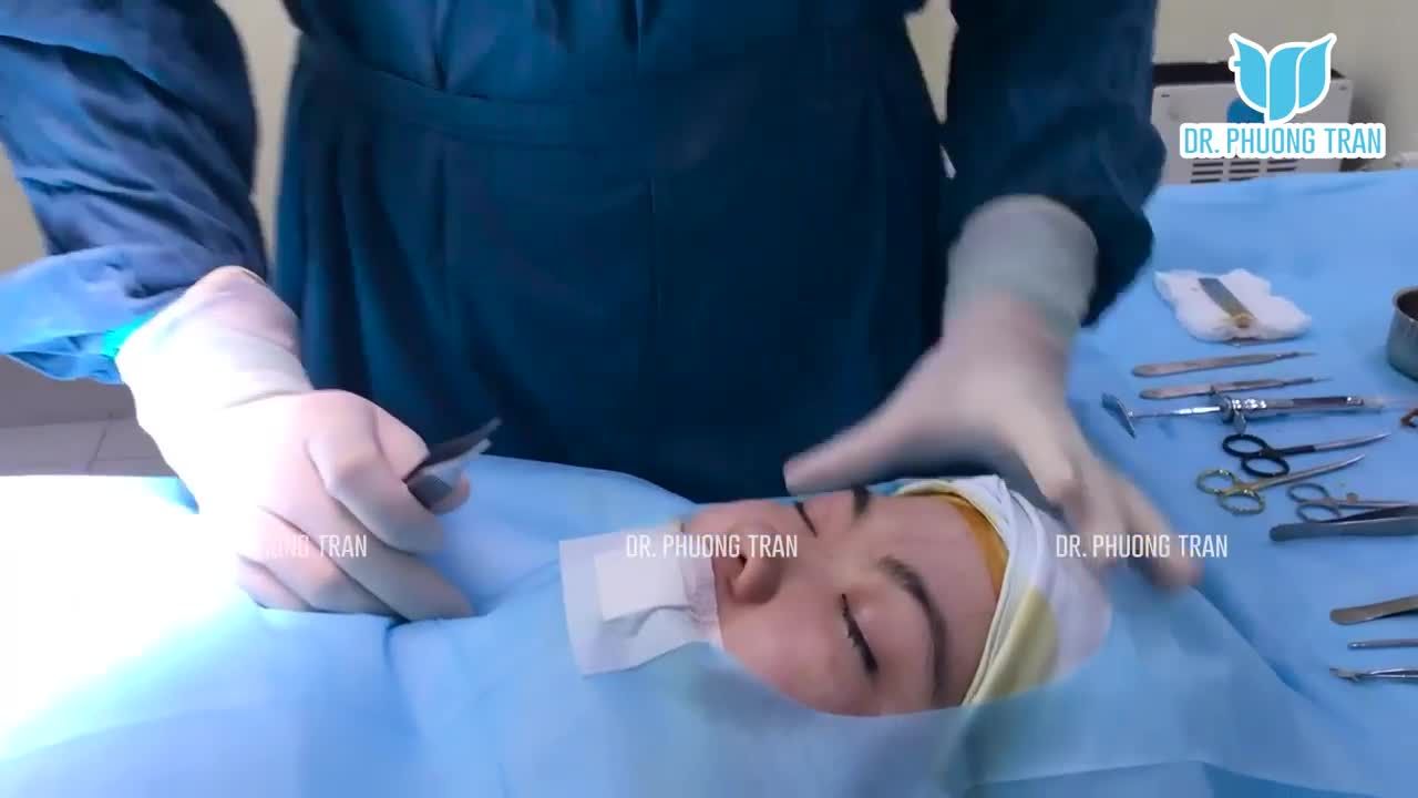 TOÀN BỘ QUY TRÌNH NÂNG MŨI SỤN SƯỜN TOÀN PHẦN