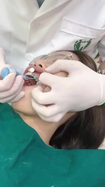 DÁN SỨ VENEER KHÔNG MÀI NHỎ LÀM 1 LẦN ĐẸP TRỌN ĐỜI