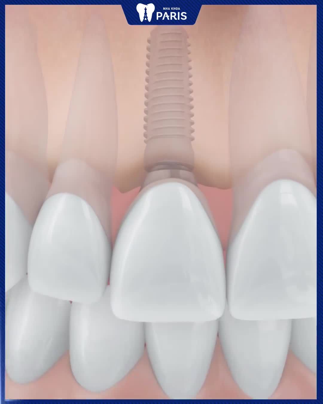 TRỒNG IMPLANT GIẢI PHÁP ĂN NHAI TRỌN VỊ TẾT