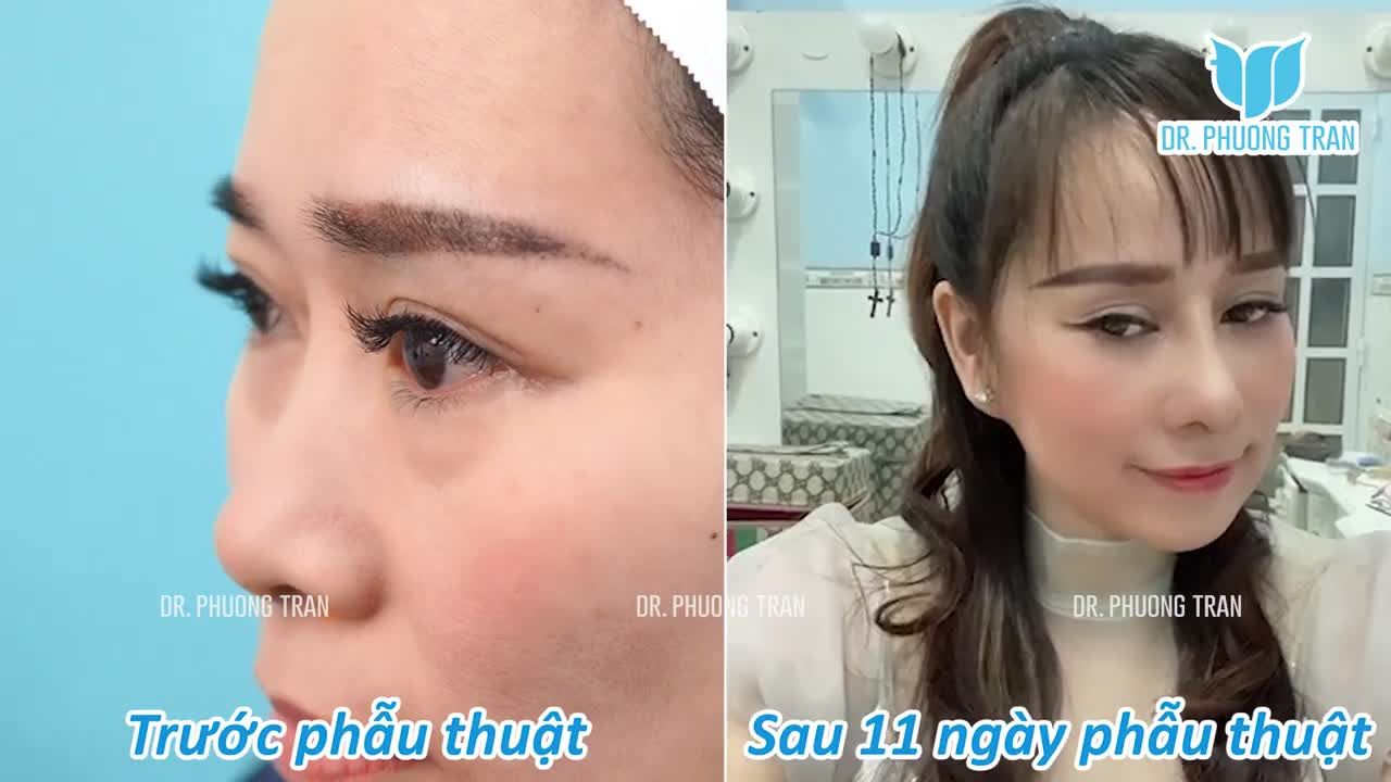 TỰ TIN KHOE SẮC CHỈ SAU 11 NGÀY THỰC HIỆN COMBO NÂNG MŨI CẤY MỠ XÓA RÃNH MŨI MÁ