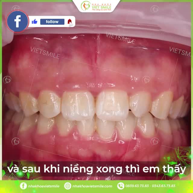 Ghé page Niềng răng Nha khoa Việt Smile để cập nhật các thông tin chuyên sâu về niềng răng cắt lợi thẩm mỹ nhé cả nhà !!!
